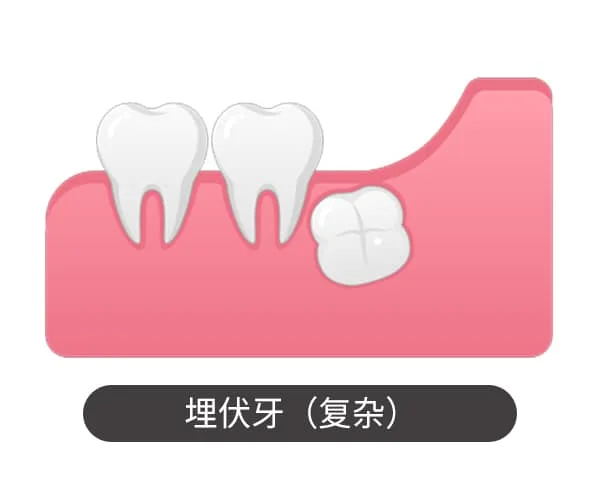 埋伏牙（复杂）