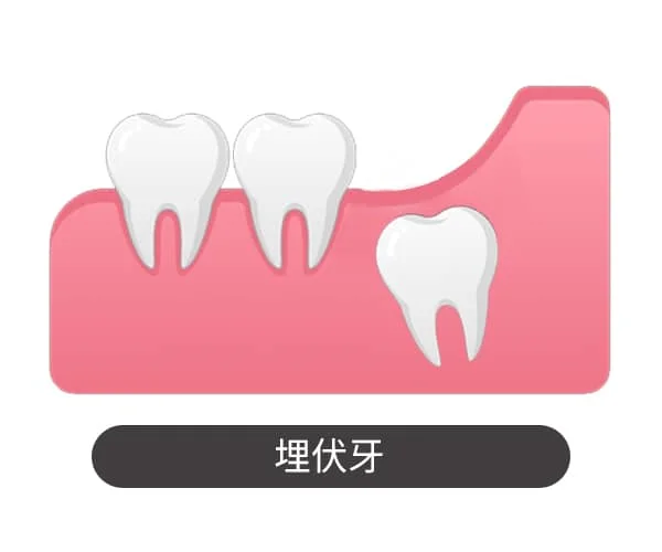 埋伏牙