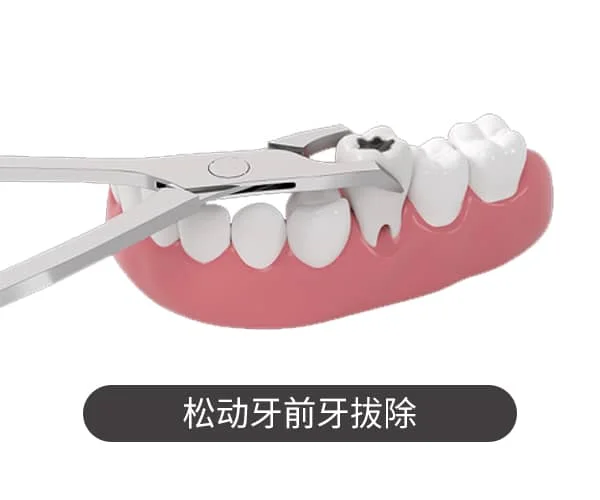 松动牙拔除