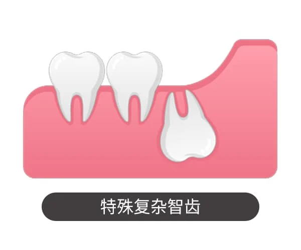 特殊复杂智齿
