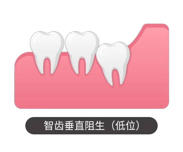 智齿垂直阻生（低位）