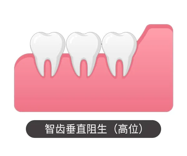 智齿垂直阻生（高位）