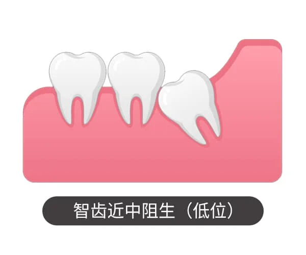 智齿近中阻生（低位）