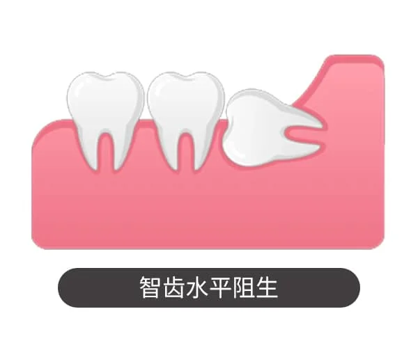 智齿水平阻生