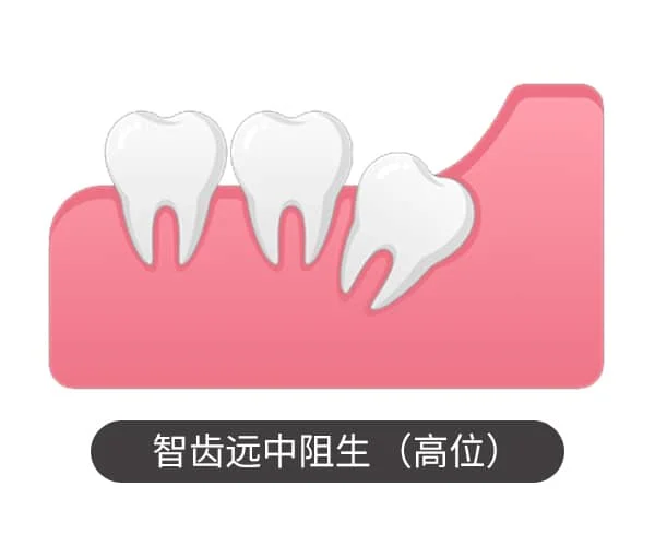 智齿远中阻生（高位）